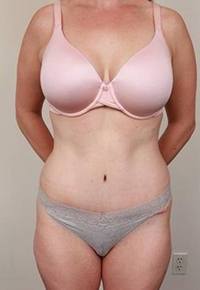 after tummy tuck female patient front view case 4331