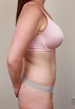 after tummy tuck female patient right side view case 4331