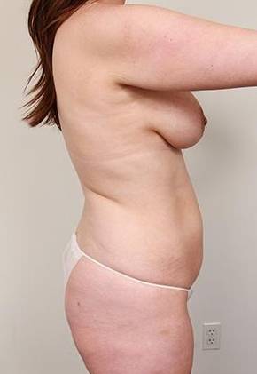 before tummy tuck female patient right side view case 4331