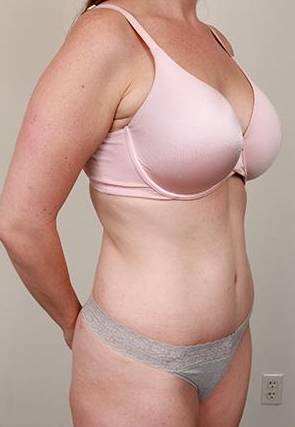 after tummy tuck female patient right angle view case 4331