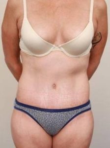 after tummy tuck female patient front view case 4352