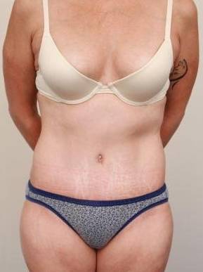 after tummy tuck female patient front view case 4352