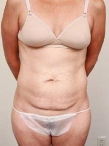 before tummy tuck female patient front view case 4352