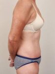 after tummy tuck female patient right side view case 4352