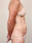before tummy tuck female patient right side view case 4352
