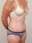 after tummy tuck female patient right angle view case 4352
