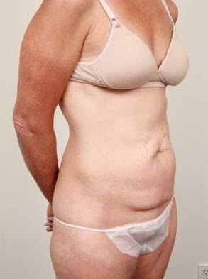 before tummy tuck female patient right angle view case 4352