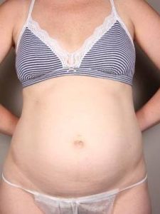before tummy tuck female patient front view case 4359