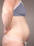 before tummy tuck female patient right side view case 4359