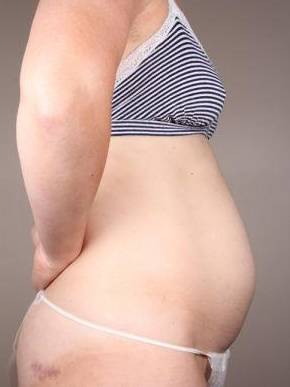 before tummy tuck female patient right side view case 4359