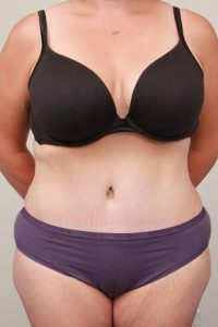 after tummy tuck female patient front view case 4366