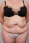 before tummy tuck female patient front view case 4366