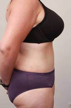 after tummy tuck female patient right side view case 4366