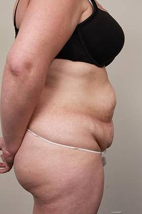 before tummy tuck female patient right side view case 4366