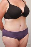 after tummy tuck female patient right angle view case 4366