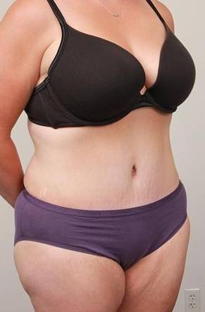 after tummy tuck female patient right angle view case 4366