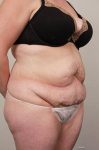 before tummy tuck female patient right angle view case 4366