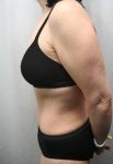 after tummy tuck female patient left side view case 4373