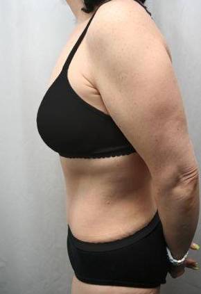 after tummy tuck female patient left side view case 4373