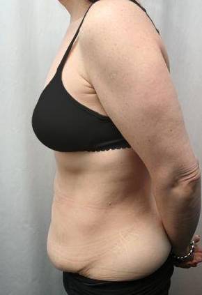 before tummy tuck female patient left side view case 4373
