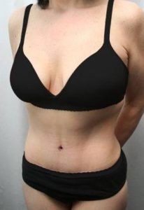 after tummy tuck female patient left angle view case 4373