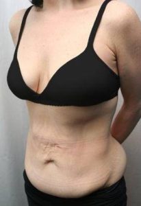 before tummy tuck female patient left angle view case 4373