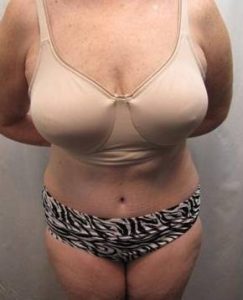 after tummy tuck female patient front view case 4378