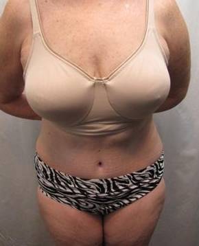 after tummy tuck female patient front view case 4378