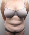 before tummy tuck female patient front view case 4378