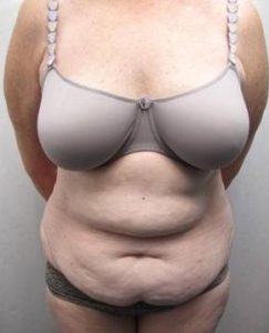 before tummy tuck female patient front view case 4378