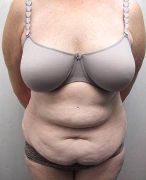 before tummy tuck female patient front view case 4378