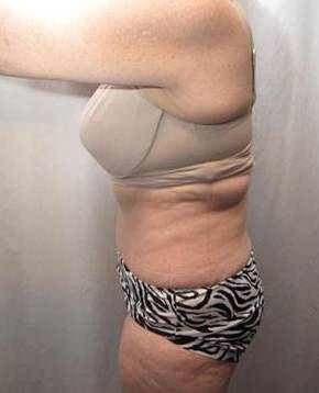 after tummy tuck female patient left side view case 4378