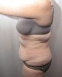 before tummy tuck female patient left side view case 4378