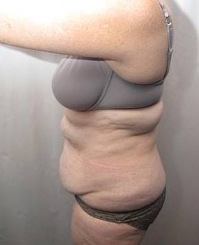 before tummy tuck female patient left side view case 4378