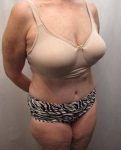 after tummy tuck female patient right angle view case 4378