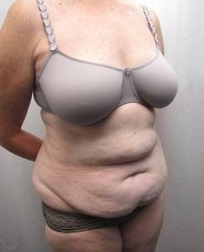 before tummy tuck female patient right angle view case 4378