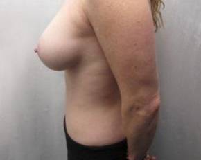 after tummy tuck female patient left side view case 4385