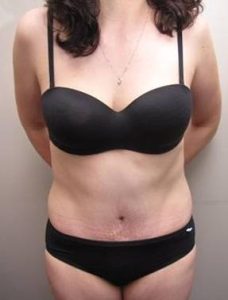 after tummy tuck female patient front view case 4390