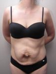 before tummy tuck female patient front view case 4390