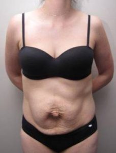 before tummy tuck female patient front view case 4390