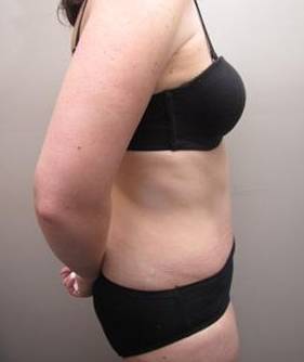 after tummy tuck female patient right side view case 4390