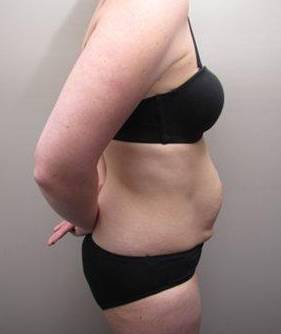 before tummy tuck female patient right side view case 4390