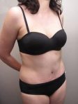 after tummy tuck female patient right angle view case 4390