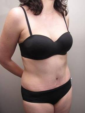 after tummy tuck female patient right angle view case 4390