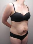 before tummy tuck female patient right angle view case 4390