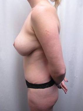 after tummy tuck female patient left side view case 4397