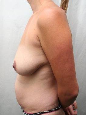 before tummy tuck female patient left side view case 4397