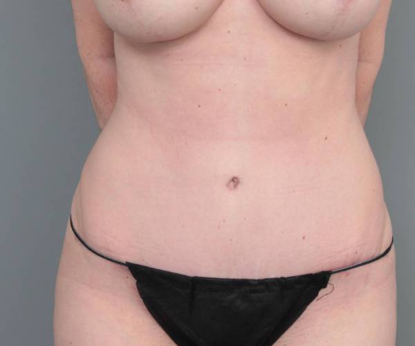 after tummy tuck female patient front view case 4404