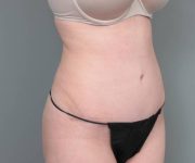 after tummy tuck female patient right angle view case 4404