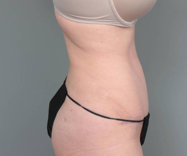 after tummy tuck female patient right side view case 4404